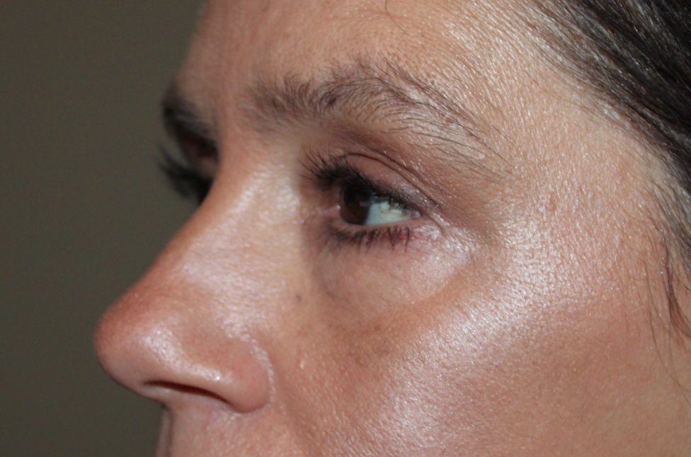 Lower Eyelid Blepharoplasty After