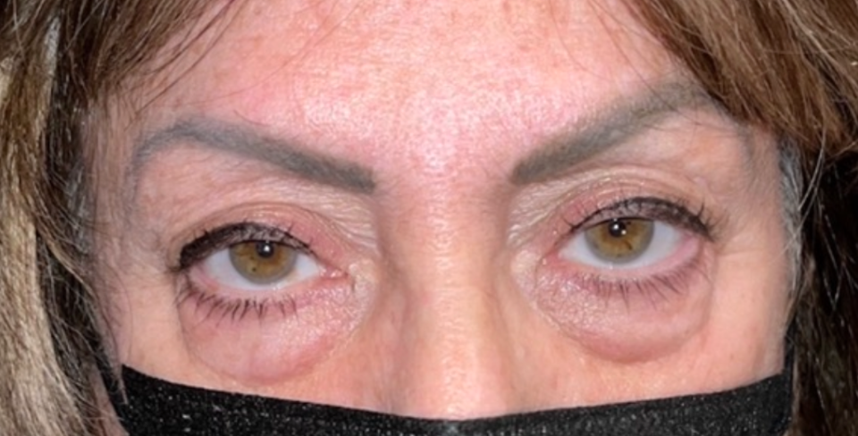 Bilateral Upper Ptosis Repair Before