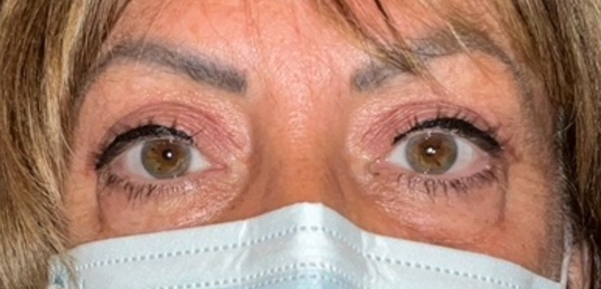 Bilateral Upper Ptosis Repair After
