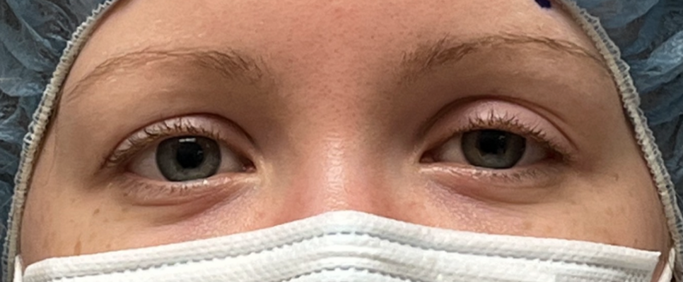 Left Ptosis Repair Before