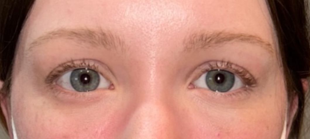 Left Ptosis Repair After