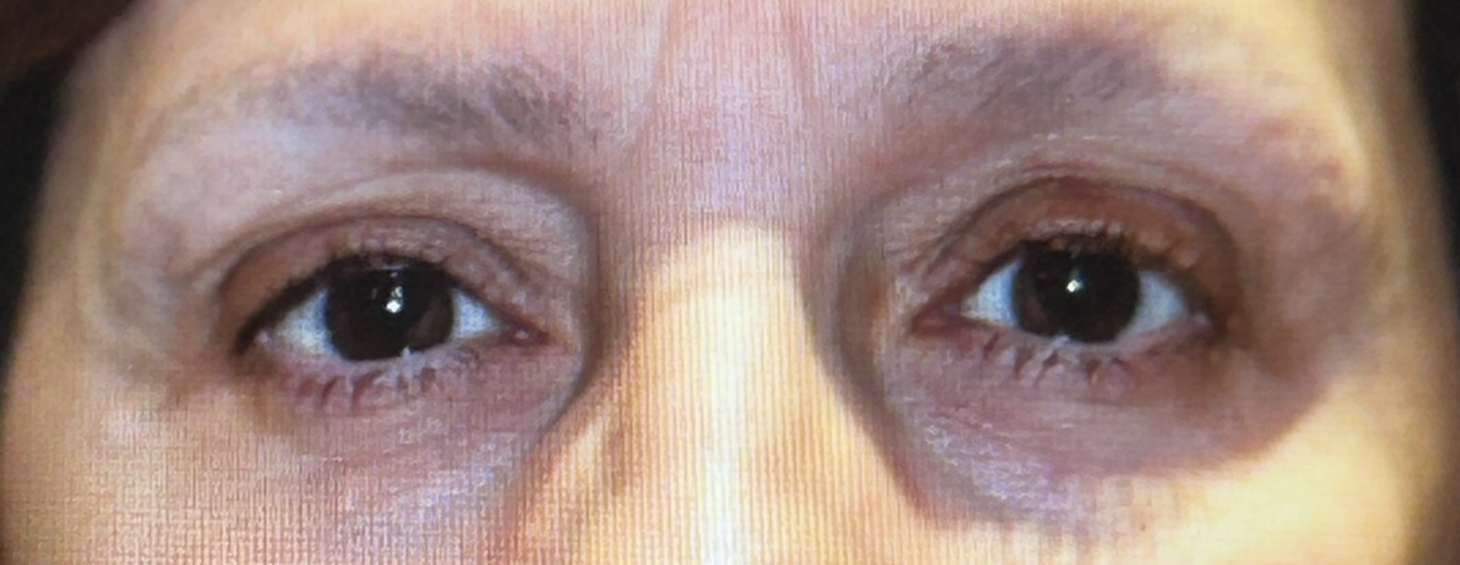 Bilateral Upper Lid Ptosis Repair After