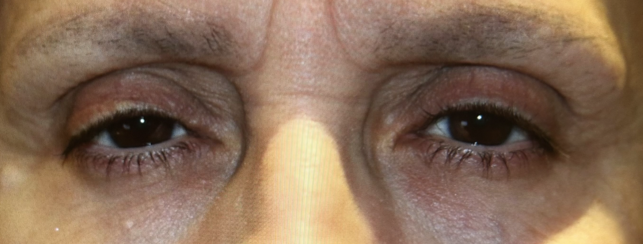 Bilateral Upper Lid Ptosis Repair Before