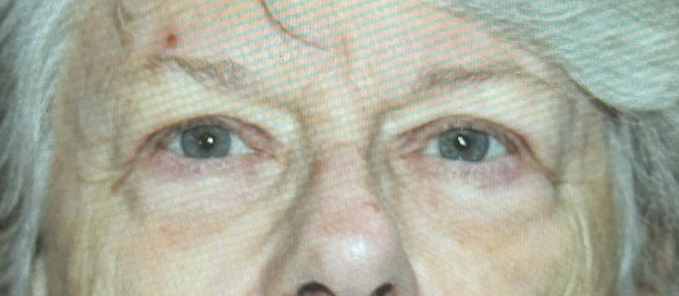 Bilateral Upper Eyelid Blepharoplasty. After