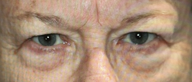 Bilateral Upper Eyelid Blepharoplasty. Before