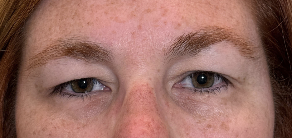 MMCR Ptosis Repair Both Upper Lids Cosmetic Blepharoplasty Both Upper Lids Before