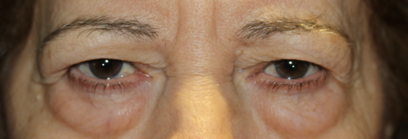 Upper & Lower Eyelid Blepharoplasty with Chemical Peel Before