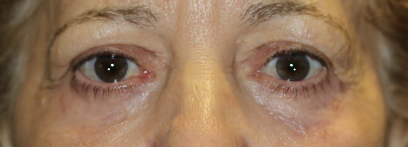 Upper & Lower Eyelid Blepharoplasty with Chemical Peel After