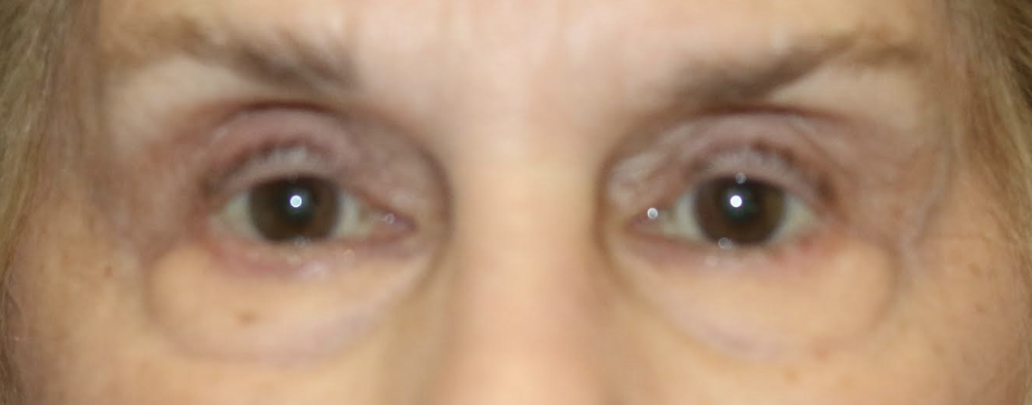 Bilateral Lower Eyelid Blepharoplasty with Chemical Peel Before
