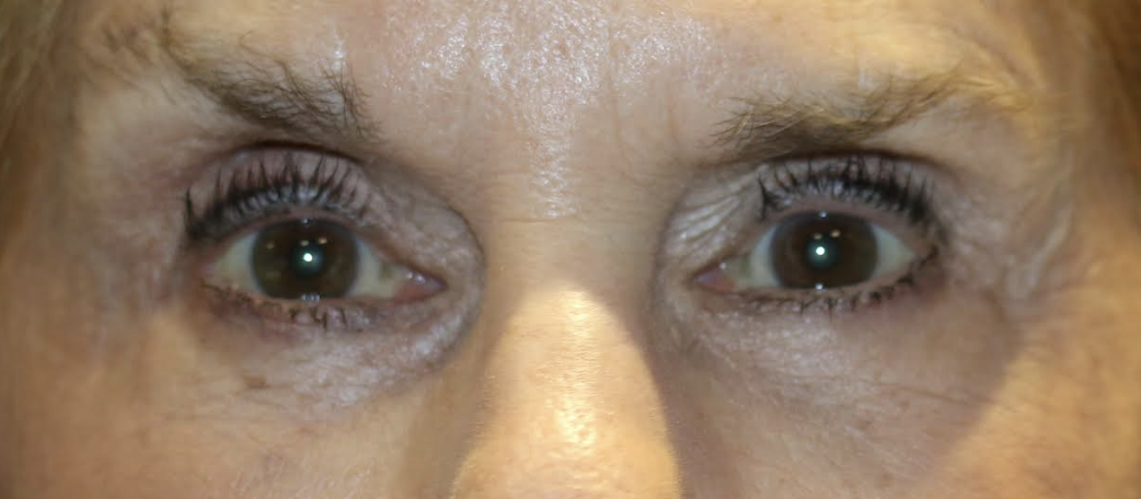 Bilateral Lower Eyelid Blepharoplasty with Chemical Peel After
