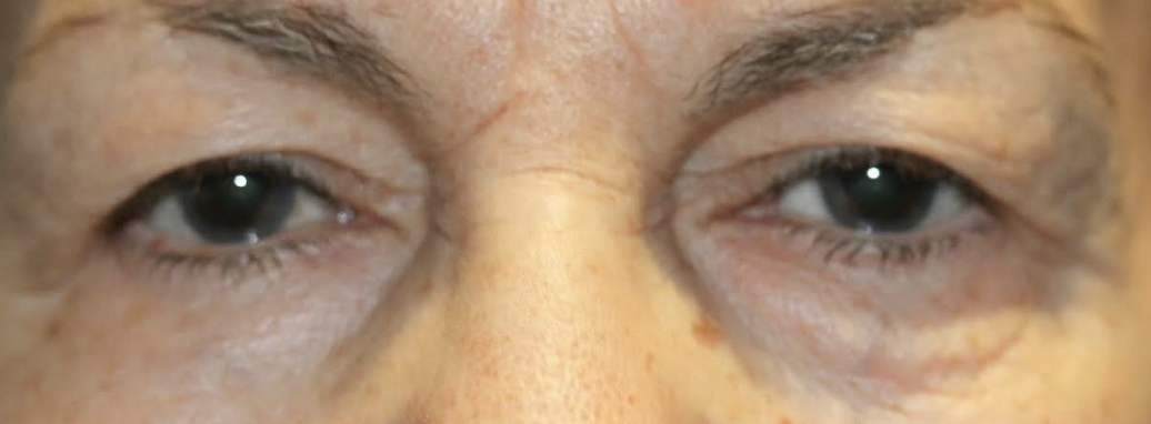 Upper & Lower Eyelid Blepharoplasty with Chemical Peel Before