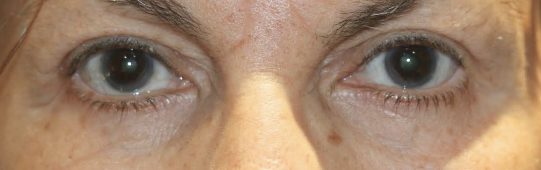 Upper & Lower Eyelid Blepharoplasty with Chemical Peel After