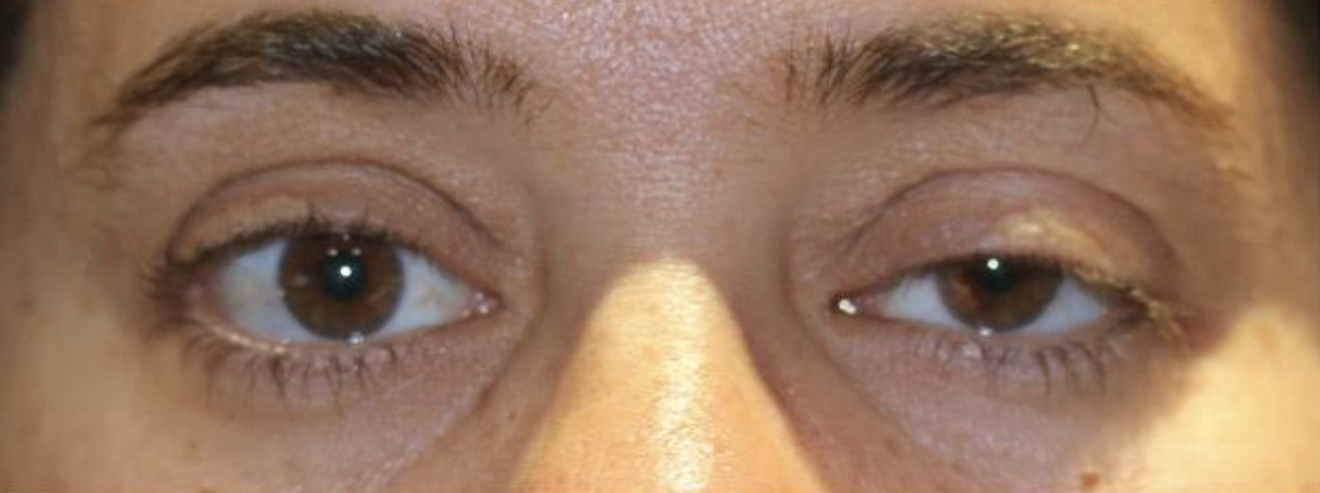 Left Upper Lid Ptosis Repair Before