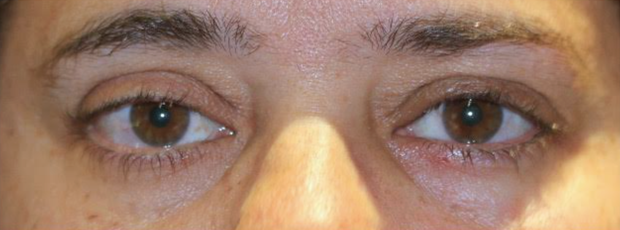 Left Upper Lid Ptosis Repair After