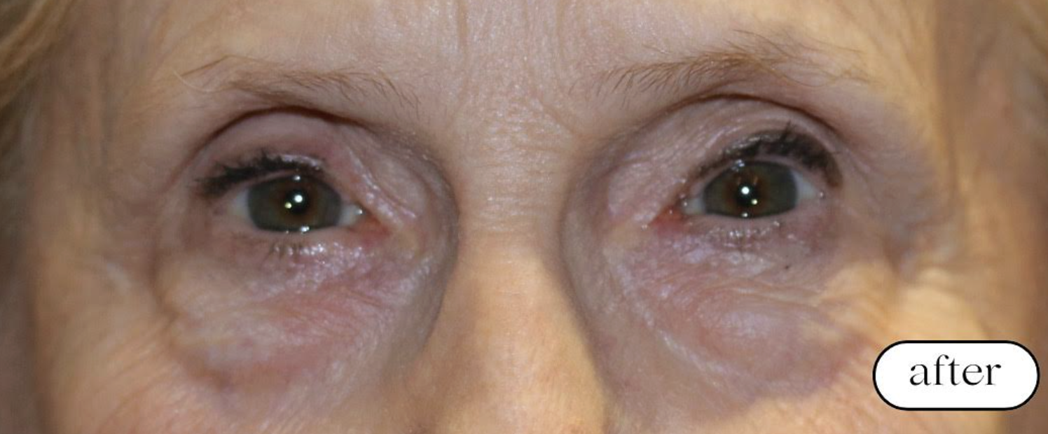 Left Upper Lid External Ptosis Repair After