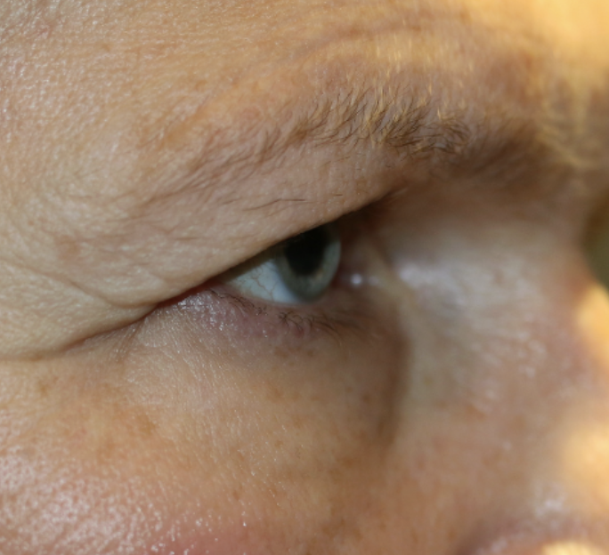 Bilateral Upper Lid Blepharoplasty with Bilateral Browpexy Before