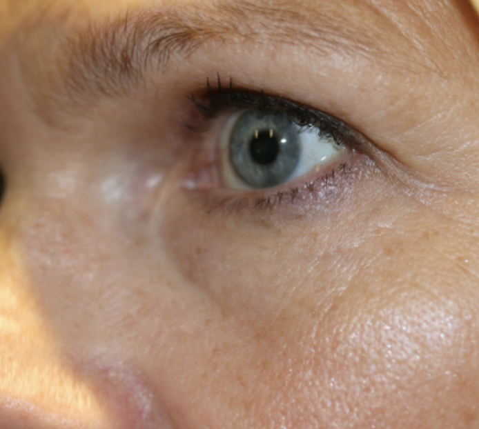 Bilateral Upper Lid Blepharoplasty with Bilateral Browpexy After
