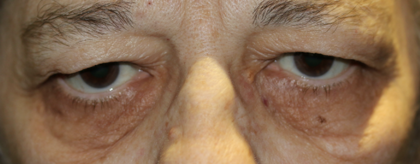 Upper Lid Blepharoplasty Before