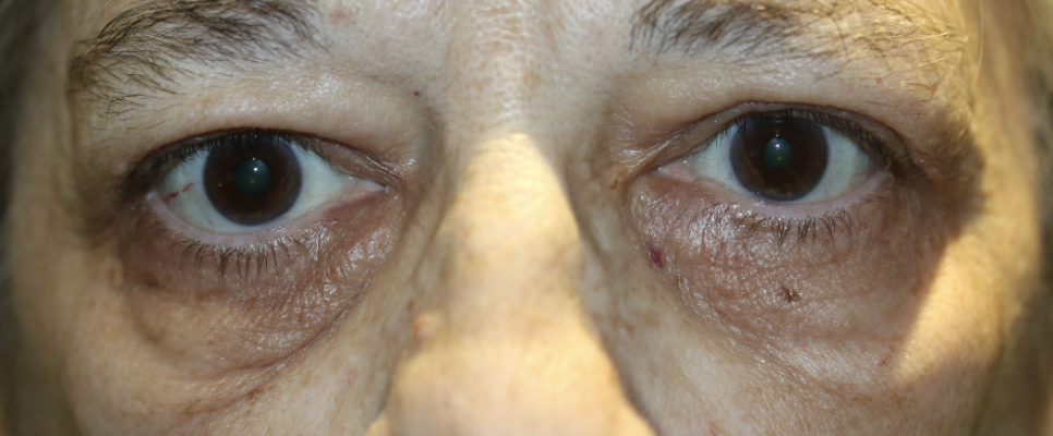 Upper Lid Blepharoplasty After