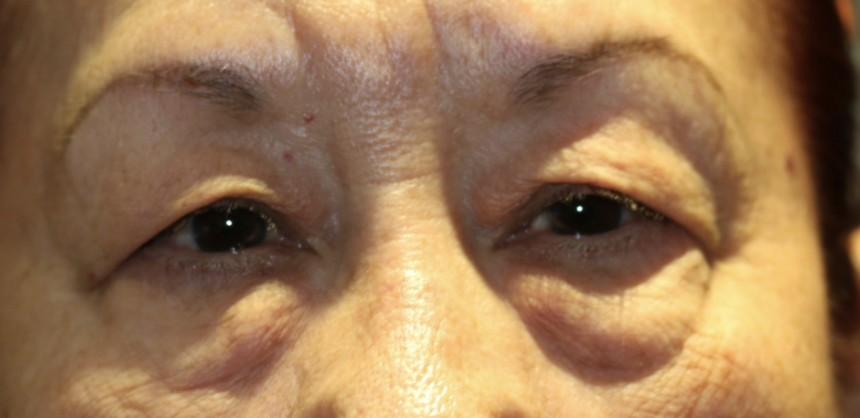 Cosmetic Bilateral Upper & Lower Blepharoplasty Before