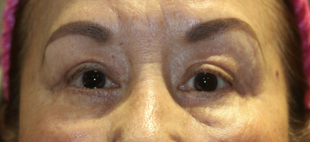 Cosmetic Bilateral Upper & Lower Blepharoplasty After
