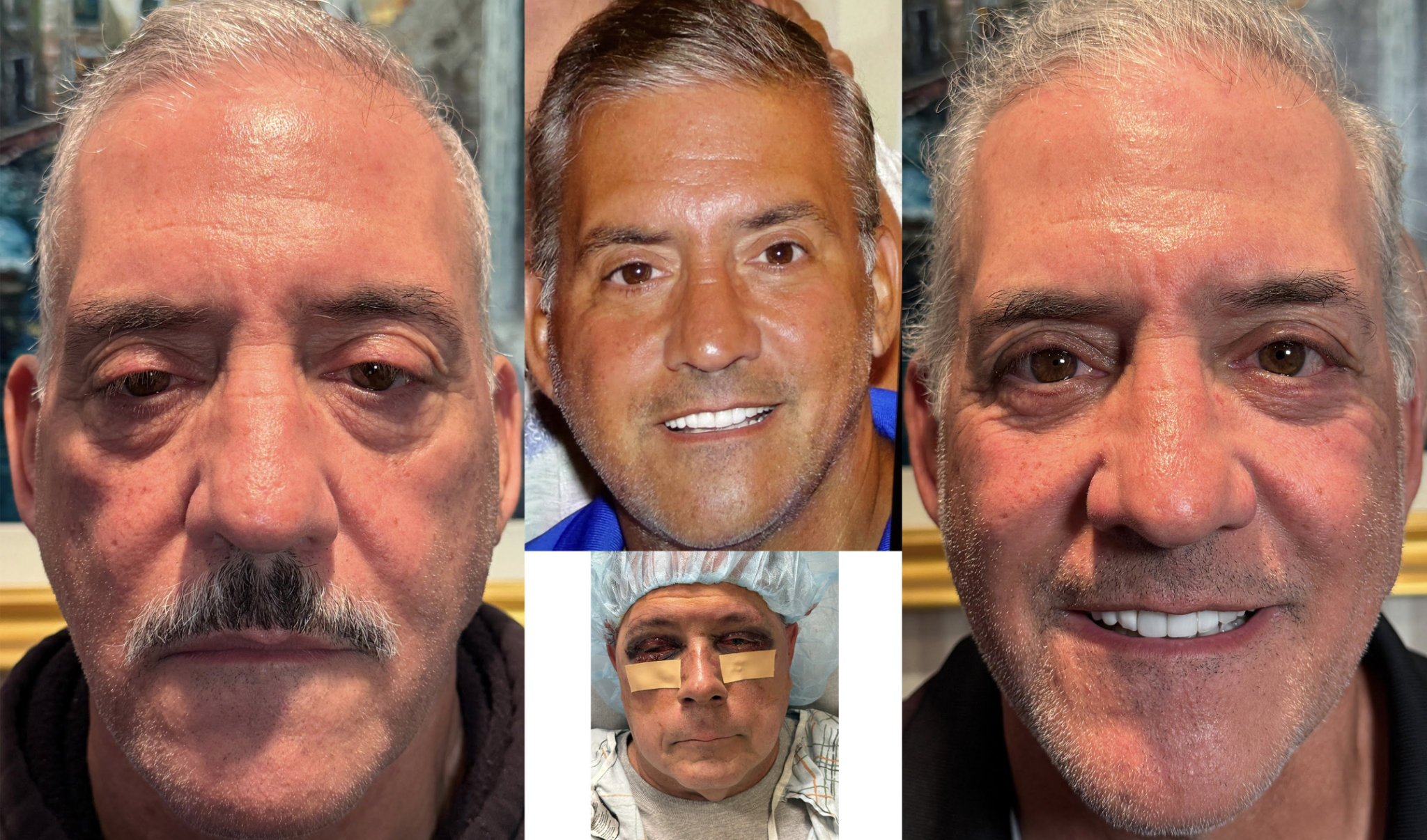 Ptosis Repair Both Upper Eyelids & Lower Eyelid Blepharoplasty with Fat Transposition