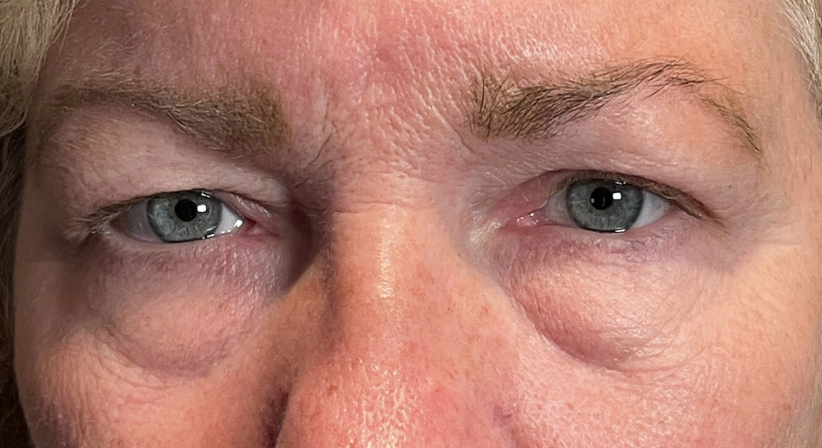 Blepharoplasty Upper and Lower Lids (with MMCR) Fat Transposition upper and Lower Eyelids Before