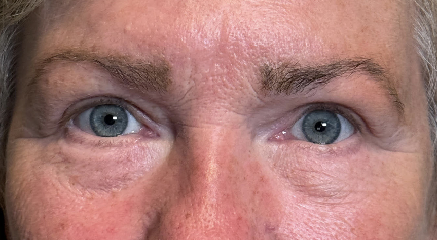 Blepharoplasty Upper and Lower Lids (with MMCR) Fat Transposition upper and Lower Eyelids After