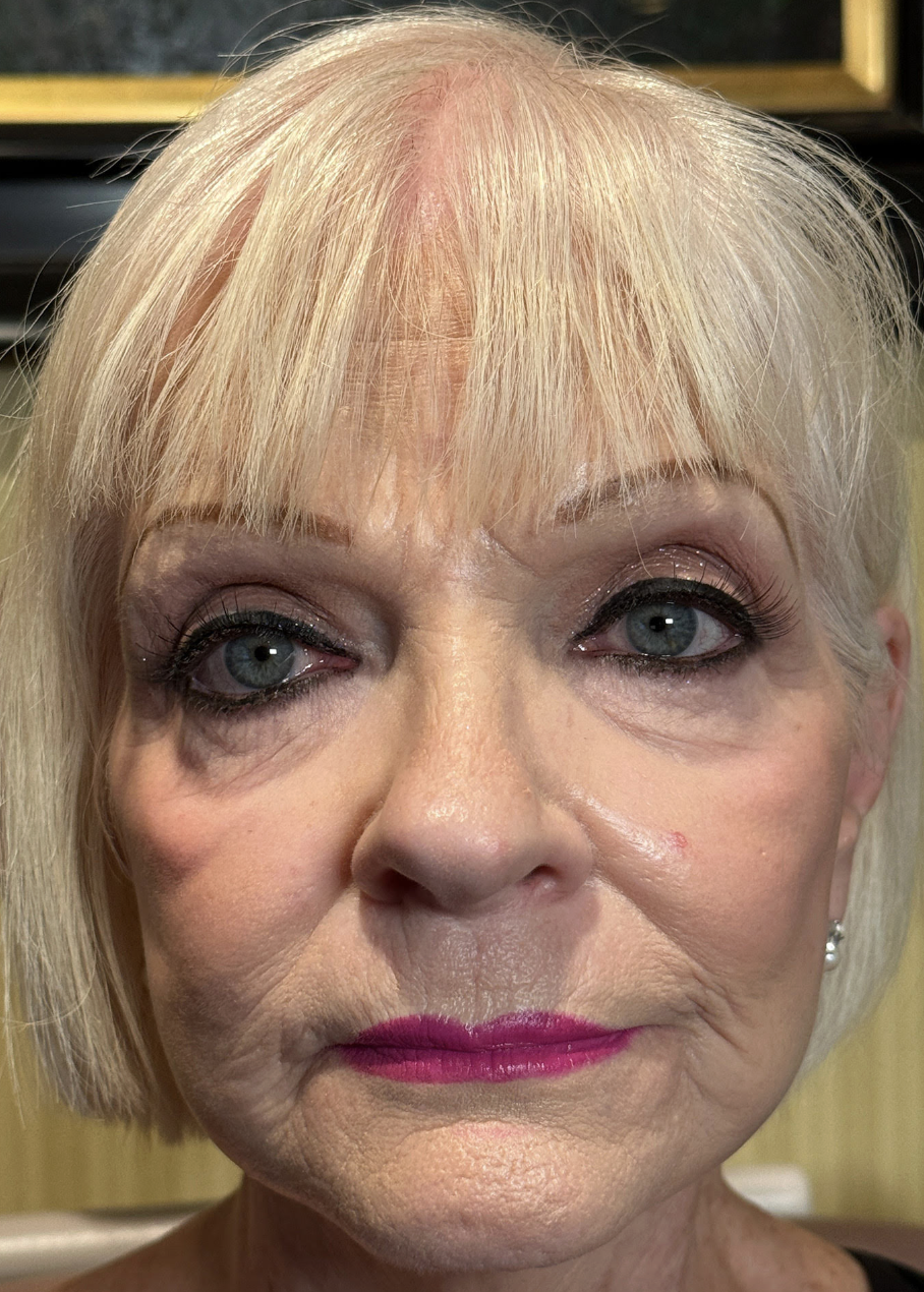 Lower Eyelid Blepharoplasty BLLs (Skin Pinch) Lateral Canthal Slings. Full Face CO2 Laser Skin Resurfacing (Aggressive Rx) Before