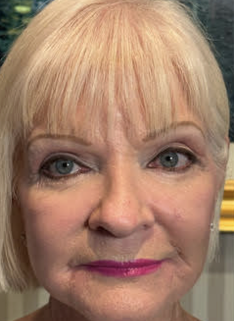 Lower Eyelid Blepharoplasty BLLs (Skin Pinch) Lateral Canthal Slings. Full Face CO2 Laser Skin Resurfacing (Aggressive Rx) After