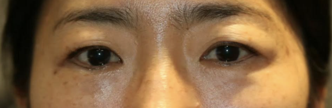 Cosmetic Upper Lid Blepharoplasty Before