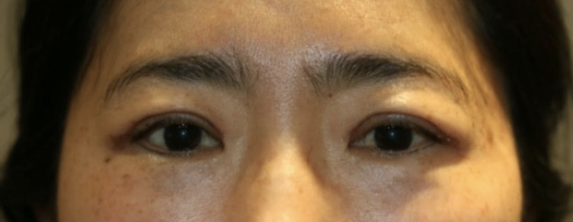 Cosmetic Upper Lid Blepharoplasty After