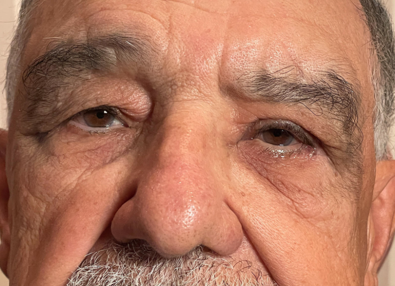 Repair of Paralysis of the Left Upper and Lower Lids & Brow Ptosis Following Severe Nerve Damage and Palsy After