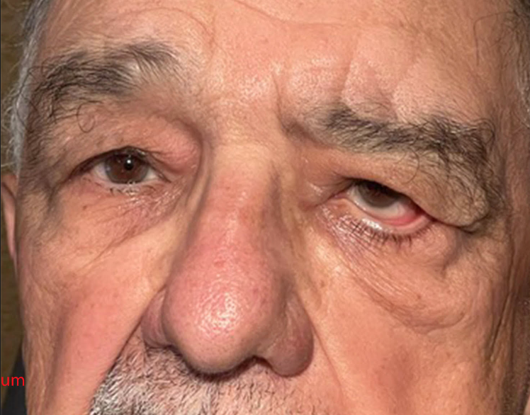 Repair of Paralysis of the Left Upper and Lower Lids & Brow Ptosis Following Severe Nerve Damage and Palsy Before