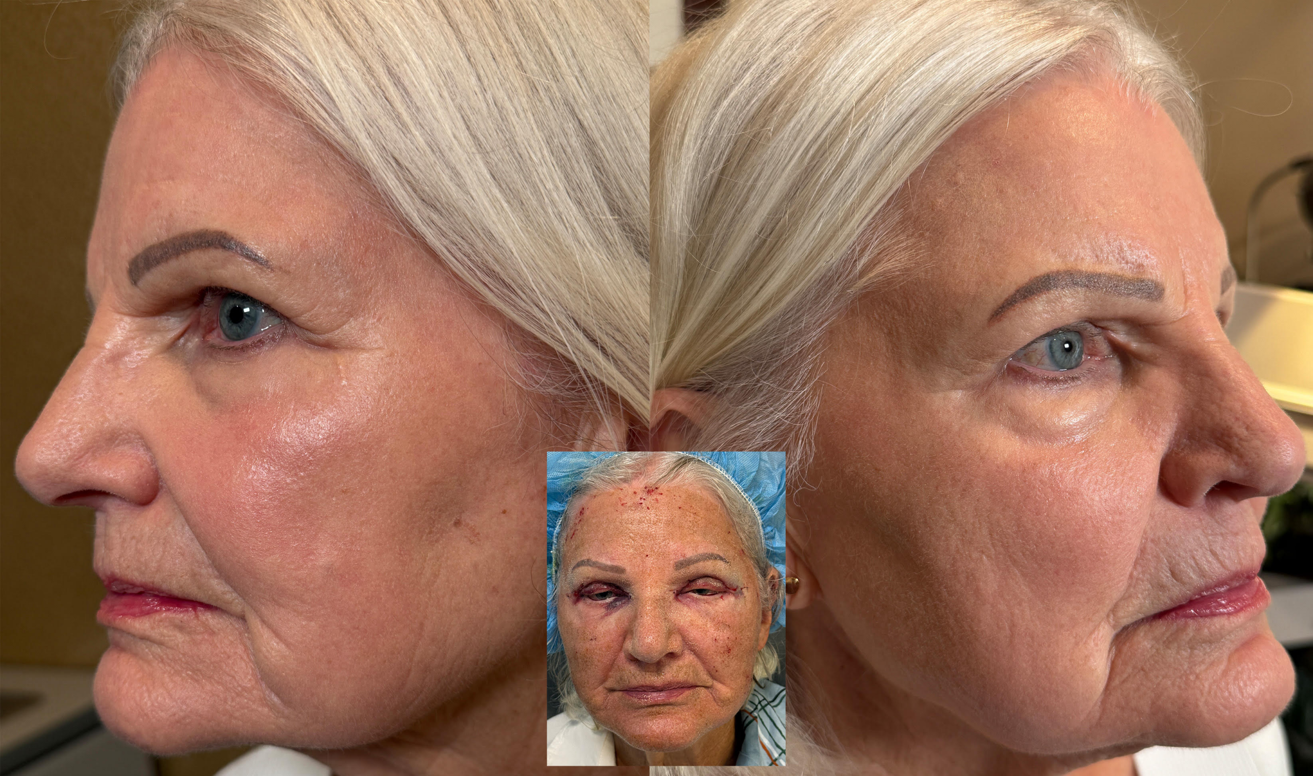 Upper Eyelid Blepharoplasty combined with Full Face CO2