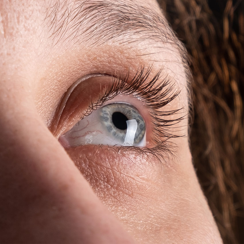 keratoconus patient
