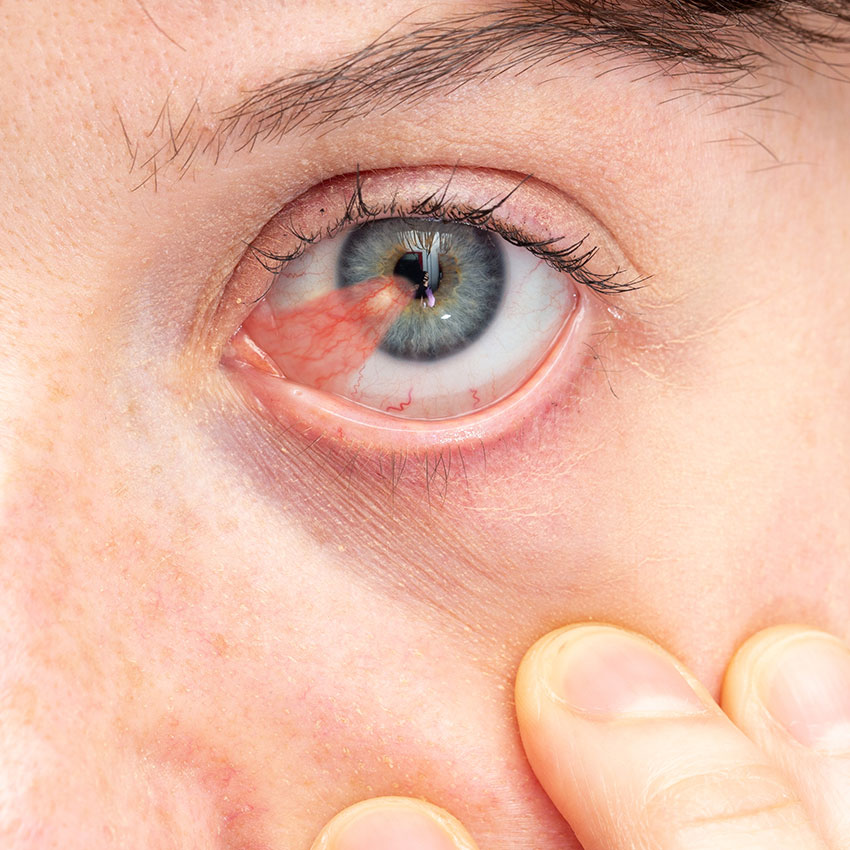 pterygium