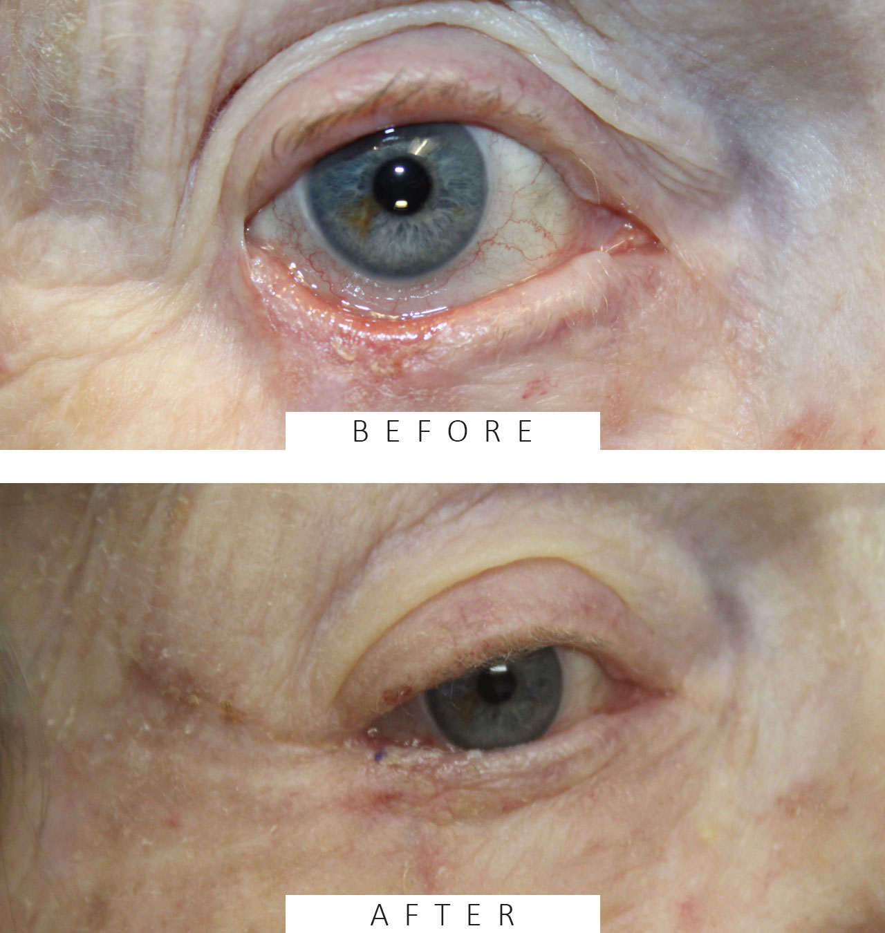 1 month following reconstruction for squamous cell carcinoma