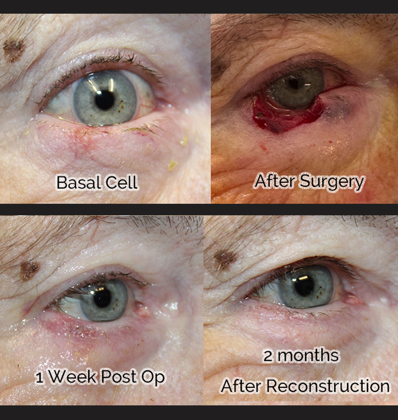 Basal Cell Carcinoma Requiring Full Thickness Wedge Reconstruction
