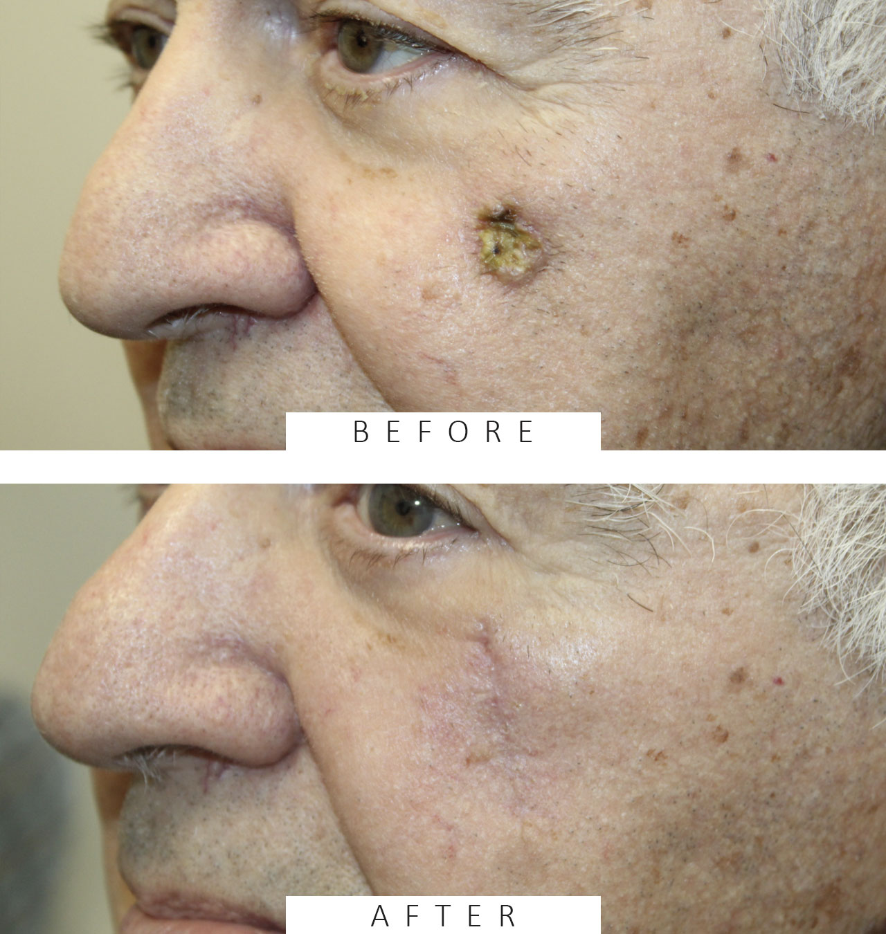 Squamous Cell Carcinoma
