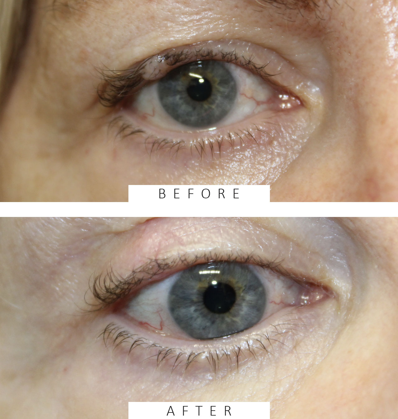 Wedge Removal for Recurrent Mole (Nevus)