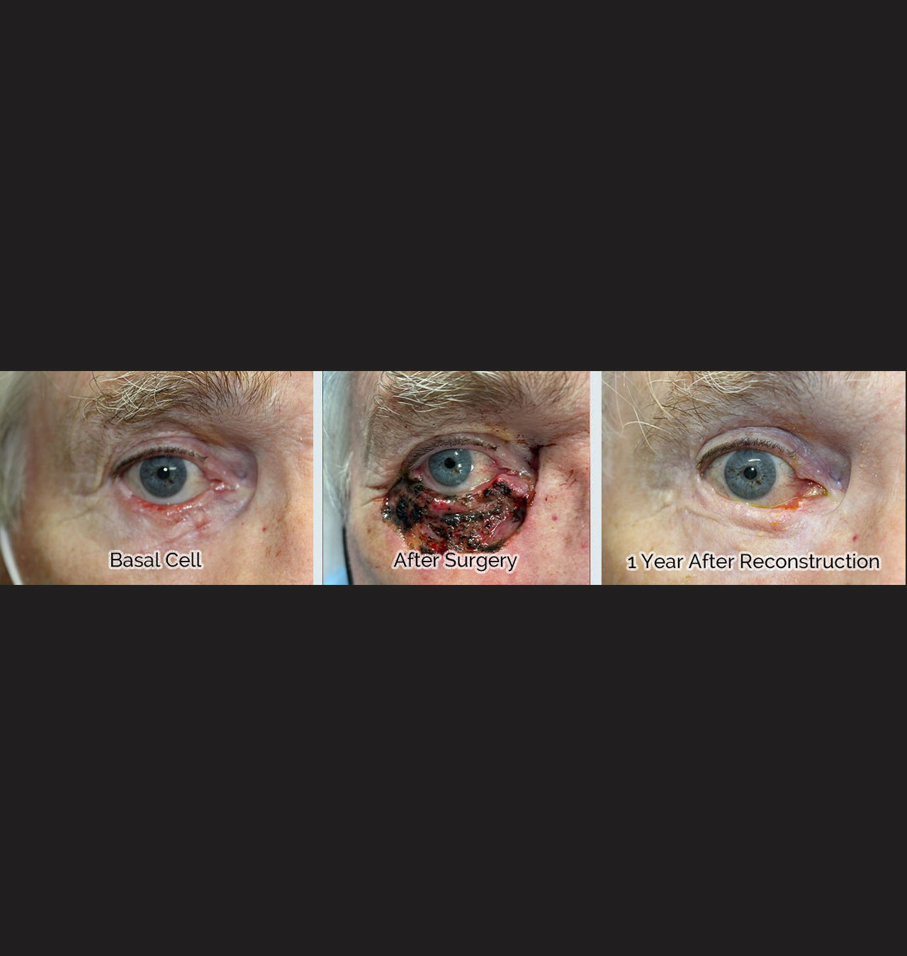 Total Lower Eyelid Reconstruction After Skin Cancer Removal