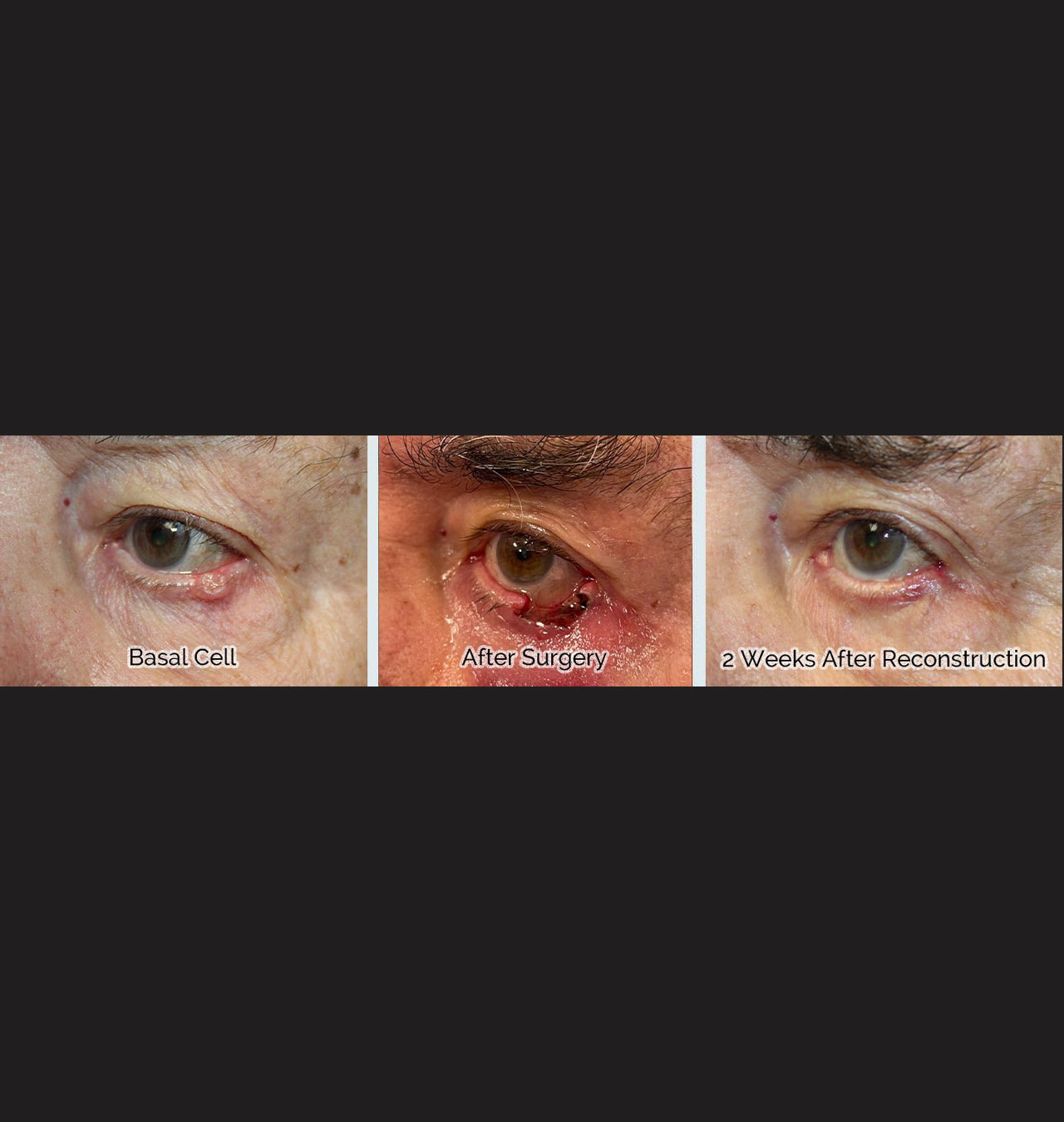 Eyelid Reconstruction After Skin Cancer Removal