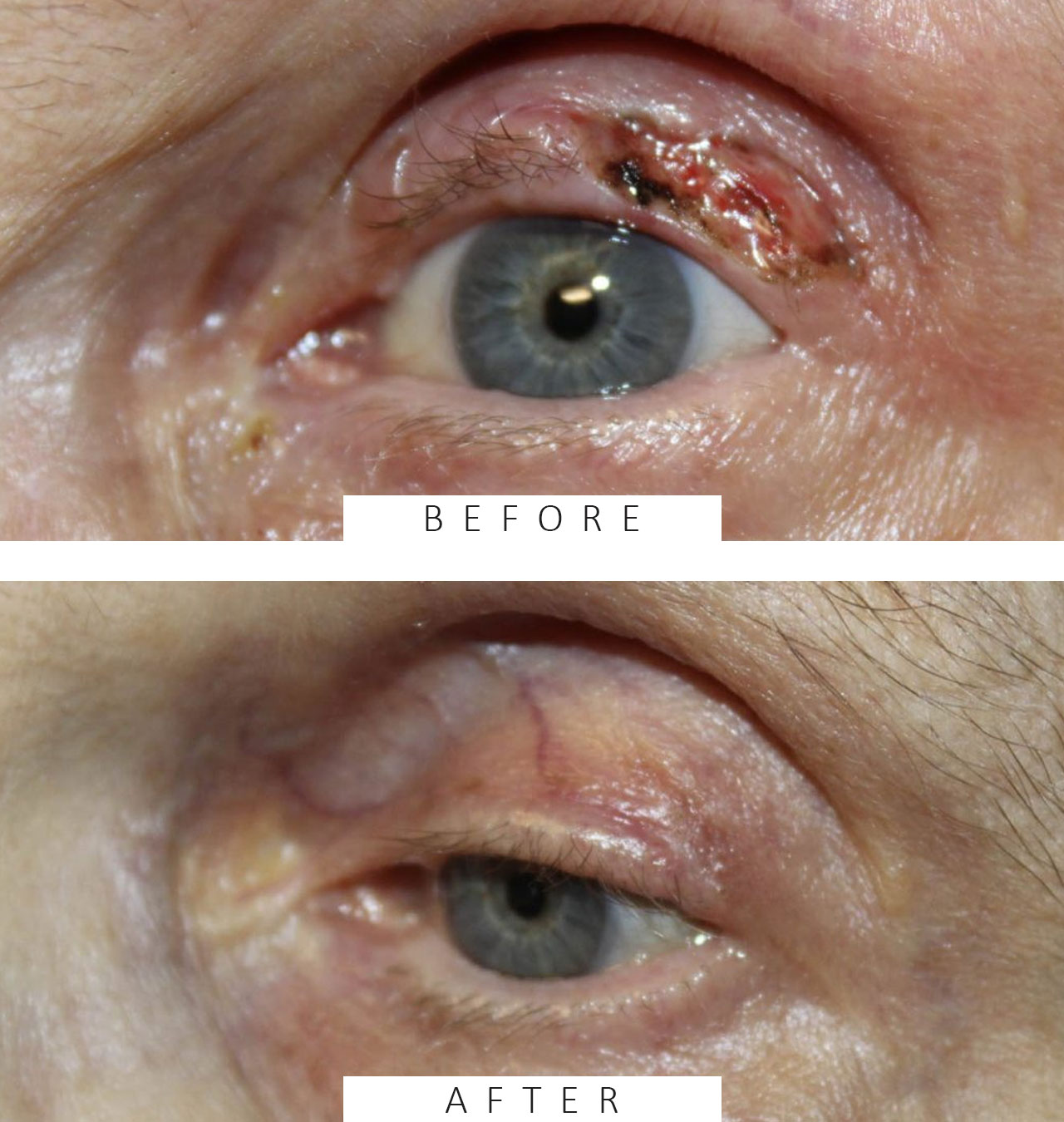 Wedge Reconstruction for Basal Cell Carcinoma of the Upper Eyelid 2 Weeks Post Op