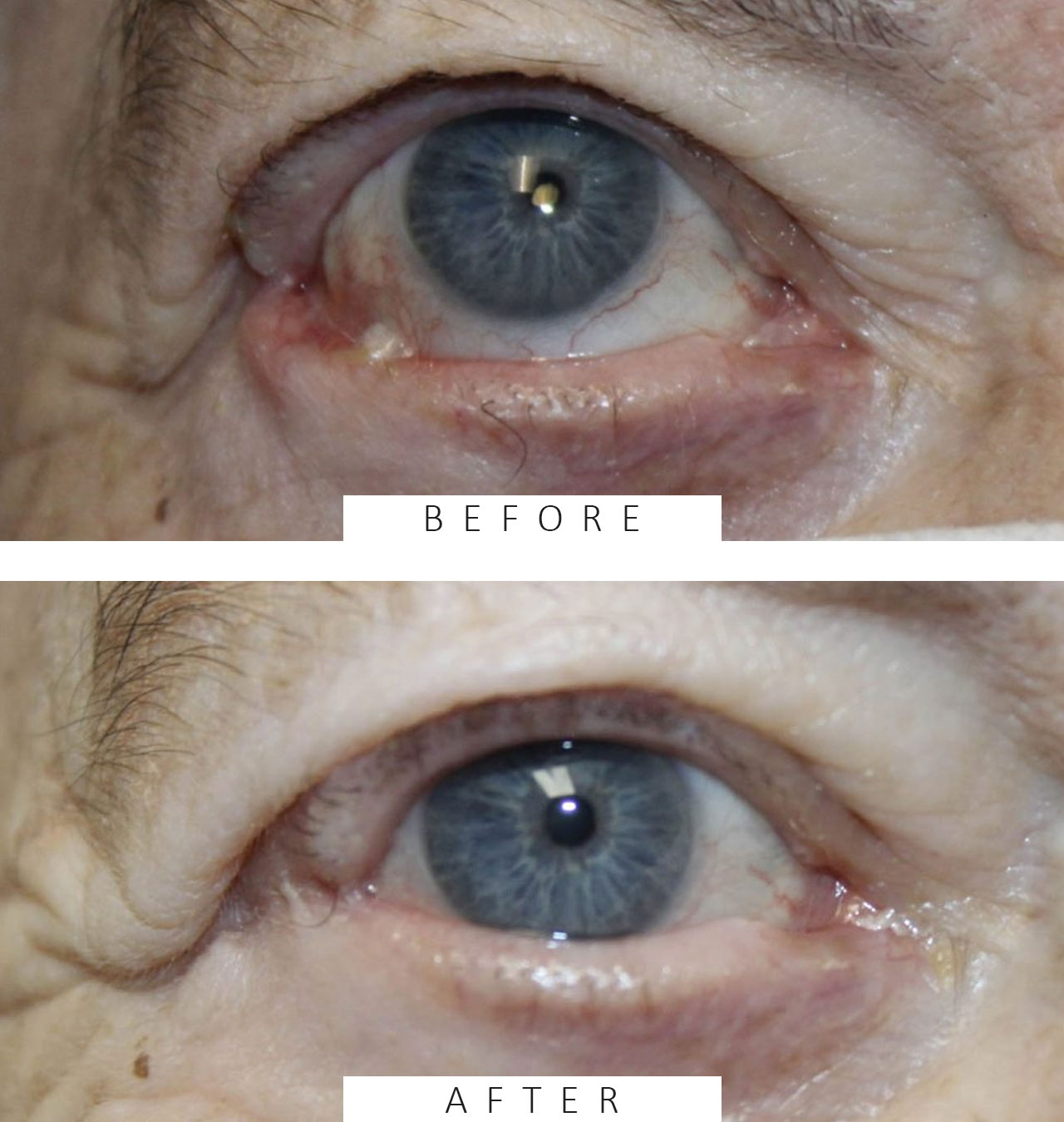 Basal Cell Cancer Involving the Upper and Lower Eyelid