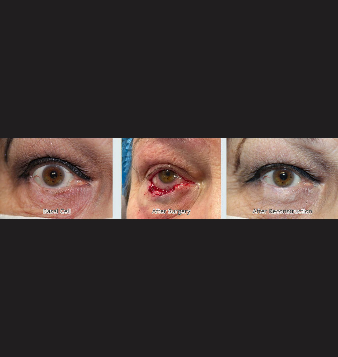 Repair of 60% Defect of Eyelid from Basal Cell Carcinoma with a Hughes flap