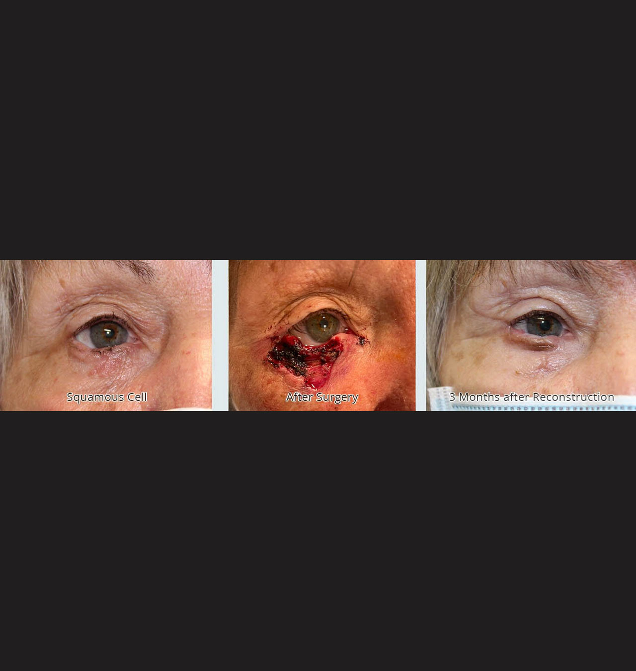 Removal of Squamous Cell Carcinoma