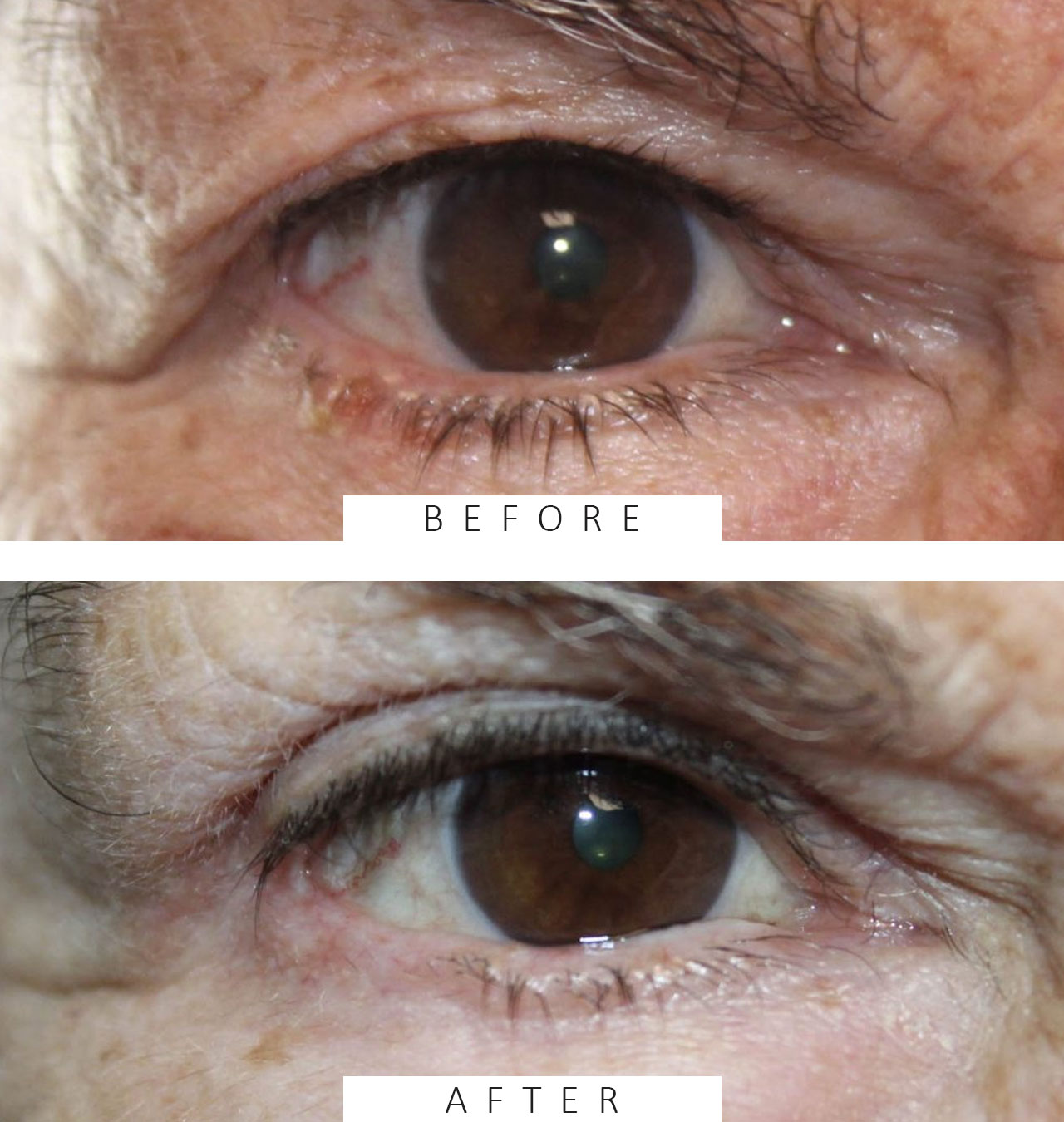 Basal Cell Carcinoma Involving 75% of the Eyelid