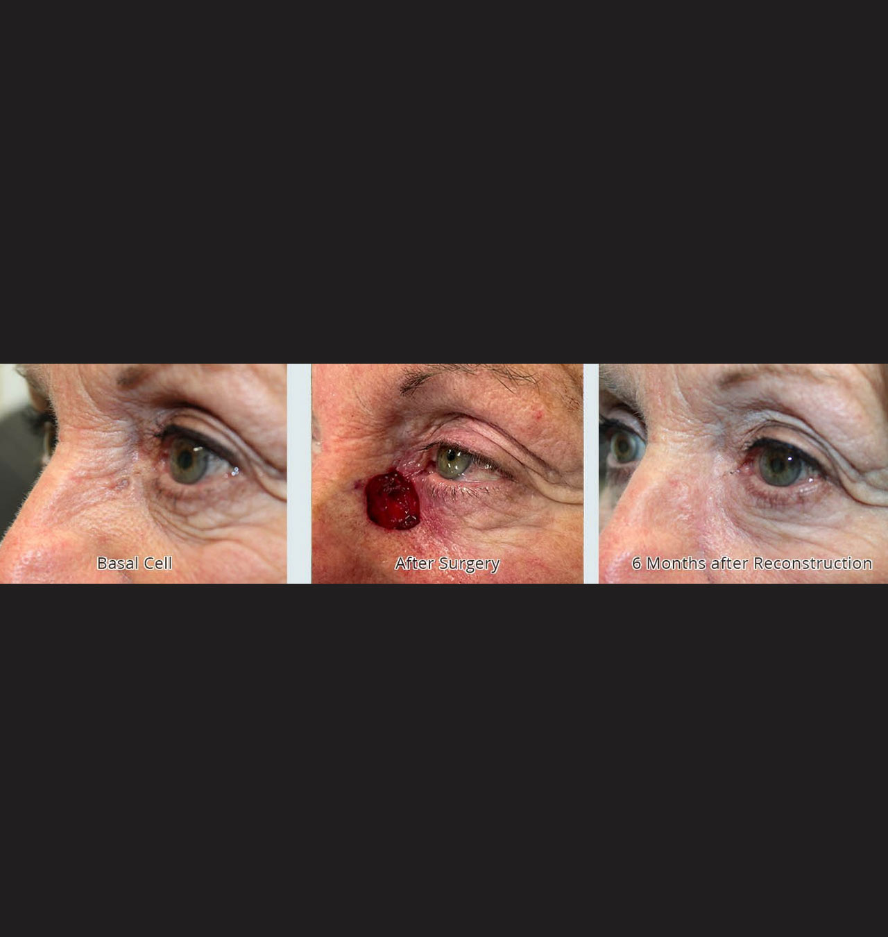 Eyelid Reconstruction