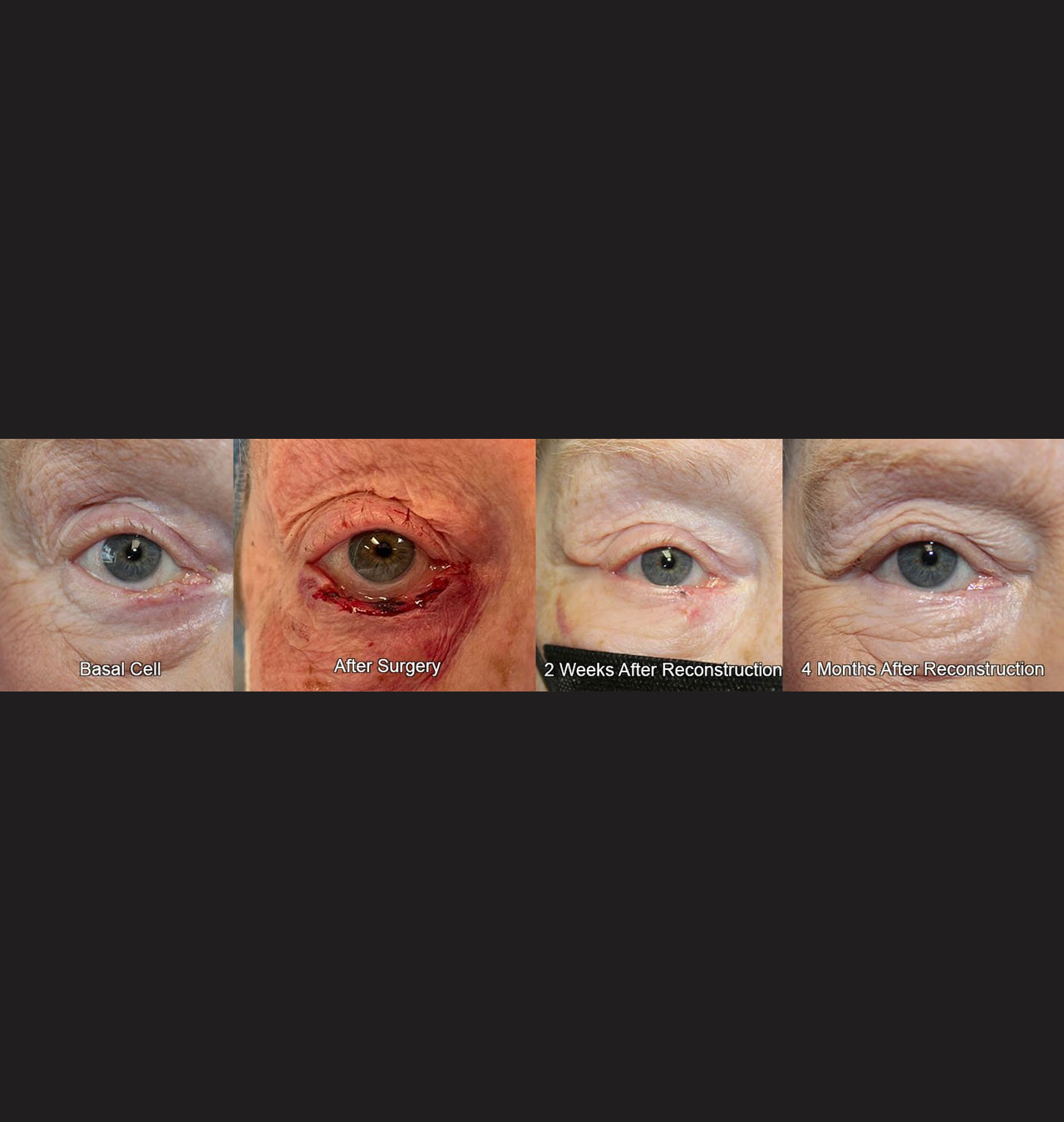 Eyelid Reconstruction